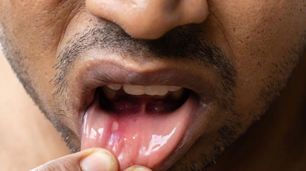How to Treat Canker Sores Naturally and Quickly: Proven Remedies That Work