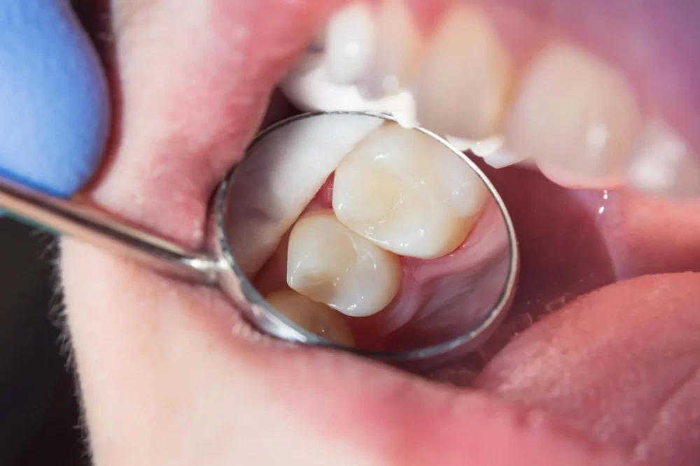 How to Care for Dental Fillings After Treatment and Ensure Long-Term Maintenance