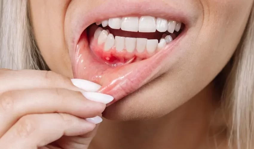 Effective Ways to Treat Oral Ulcers Caused by Braces for Faster Healing