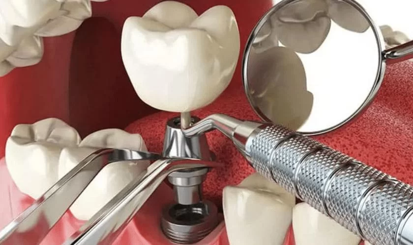 Effective Aftercare Instructions and Tips for Caring for Dental Implants