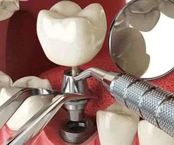 Effective Aftercare Instructions and Tips for Caring for Dental Implants
