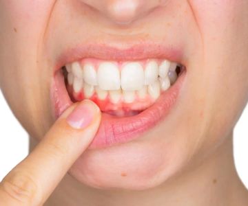 Effective Ways to Treat Bleeding Gums During Pregnancy for Healthy Oral Care