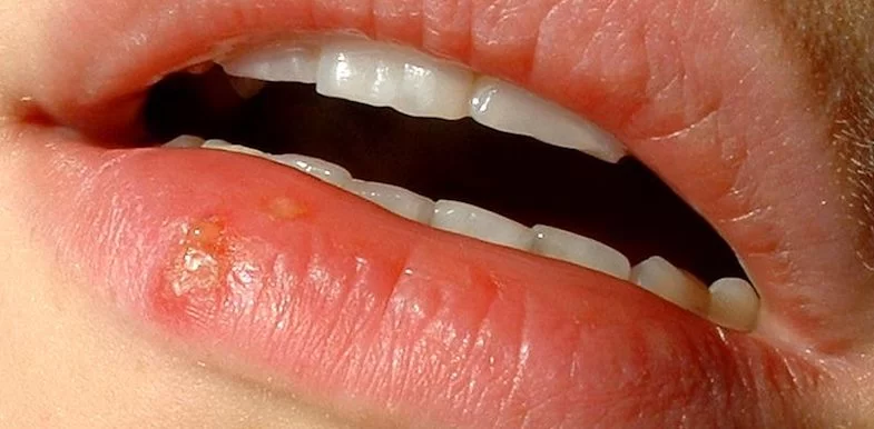 Identifying Signs of Oral Herpes Infection and Effective Management Strategies