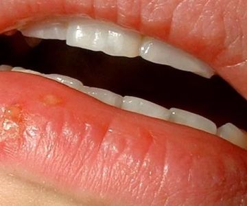 Identifying Signs of Oral Herpes Infection and Effective Management Strategies