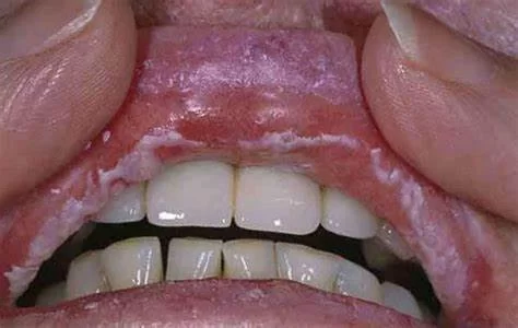 What Diseases Does Diflucan Cure? Effective Oral Thrush and Fungal Infection Treatment