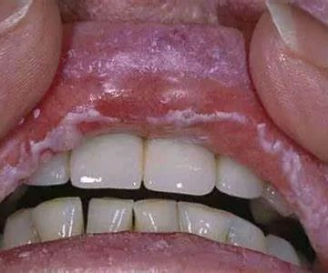 What Diseases Does Diflucan Cure? Effective Oral Thrush and Fungal Infection Treatment