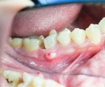 Signs of Gum Abscess: Symptoms, Treatment Options, and Care Tips