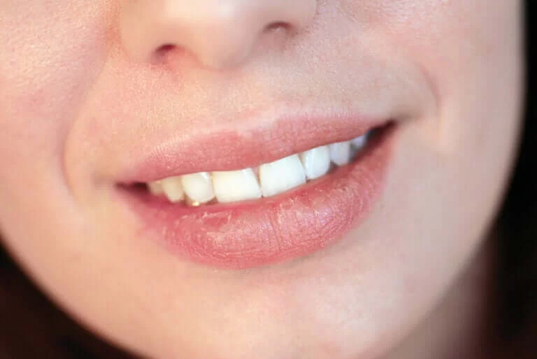 Causes of Dry Lips Due to Oral Health Issues and How to Address Them