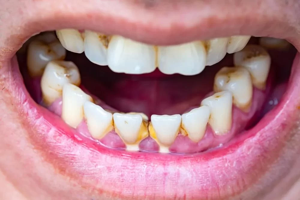 How to Describe Poor Oral Hygiene: Causes, Effects, and Solutions