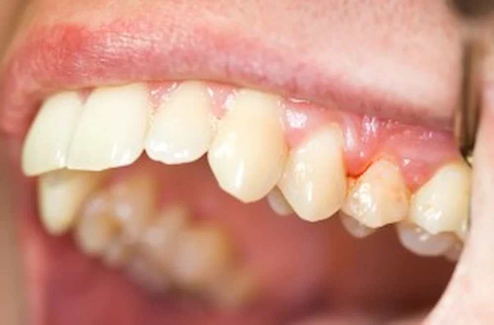 How to Treat Bleeding Gums Caused by Brushing Too Hard and Available Solutions