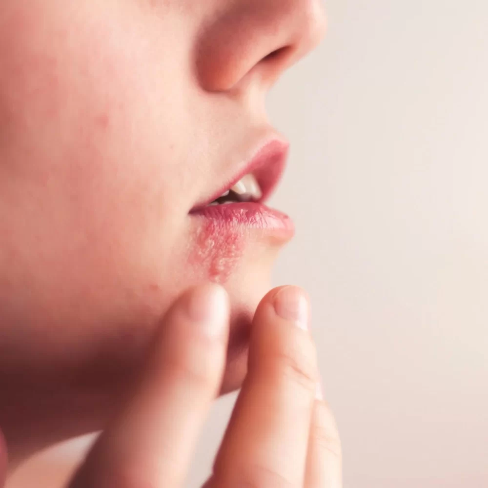 How to Check for Oral Herpes: Symptoms, Testing, and Treatment Guide