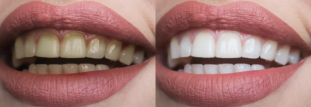 How to Whiten Teeth After Dental Cleaning Safely and Effectively