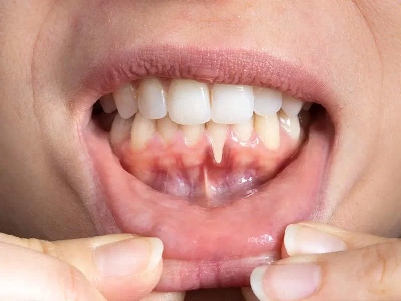 Can You Get Gum Disease from Oral Sex? What Science Really Says