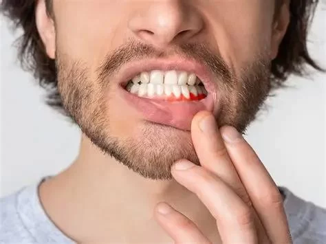 How to Prevent Gum Bleeding After Dental Cleaning: Effective Tips for Healthy Gums