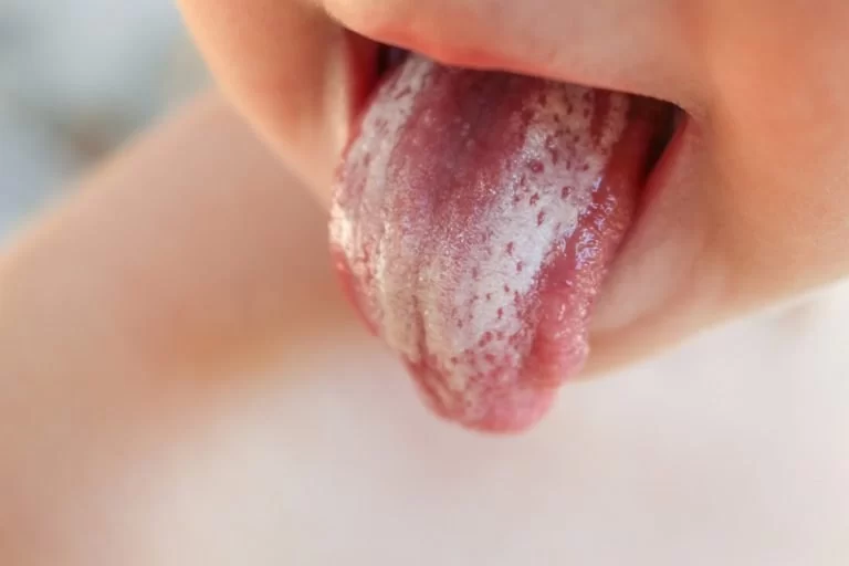 Can Autoimmune Diseases Cause Oral Thrush? What You Need to Know