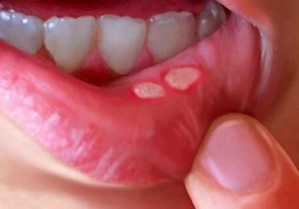 Understanding Oral Ulcers: Causes, Symptoms, and Treatment