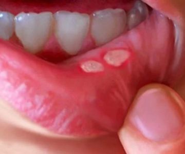 Understanding Oral Ulcers: Causes, Symptoms, and Treatment