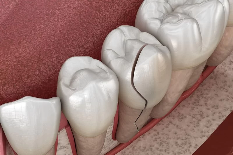 Causes of Tooth Enamel Cracking and Repair Options That Work