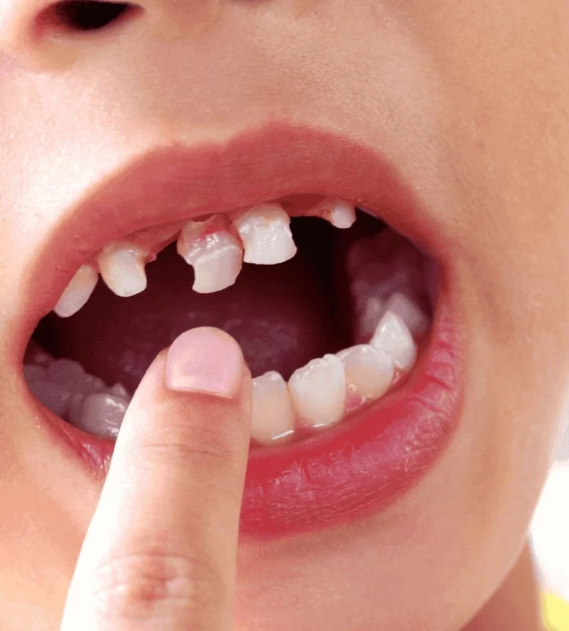 How to Prevent Teeth Grinding in Children: Expert Tips for Parents
