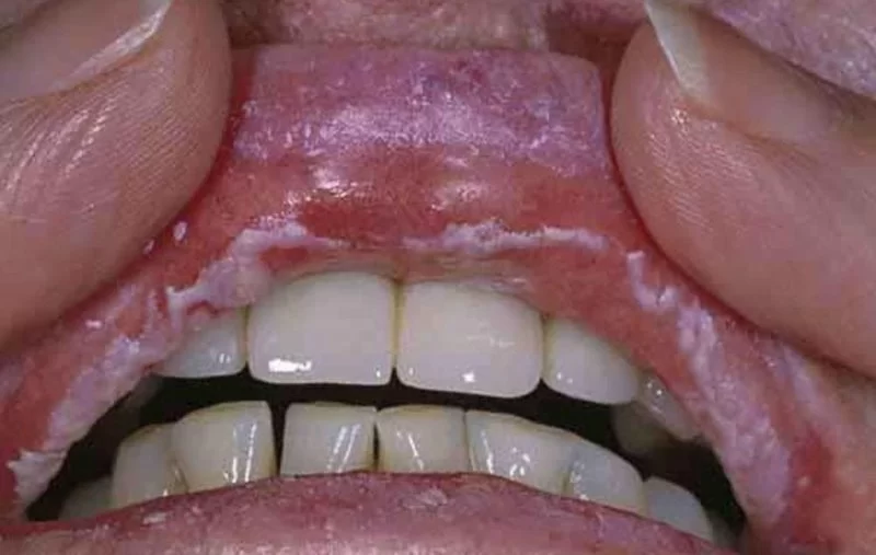 Common Signs of Oral Fungal Infection in Seniors and How to Spot Them
