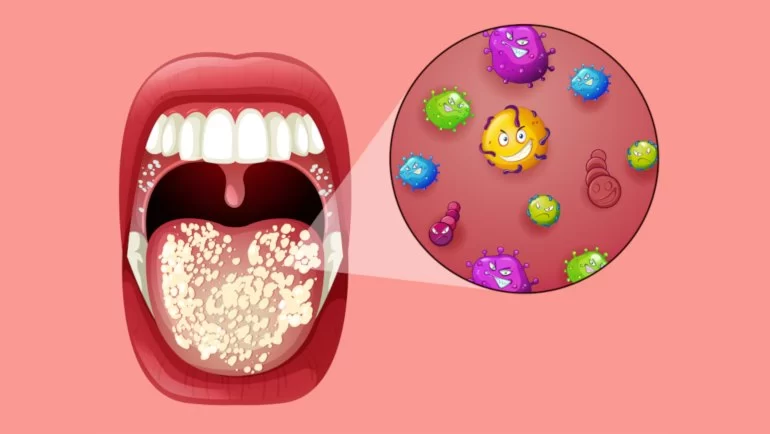 Can Oral Probiotics Cure Gum Disease? Science and Solutions Explained