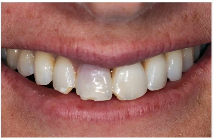 How to Fix a Chipped Tooth at Home Safely and Effectively