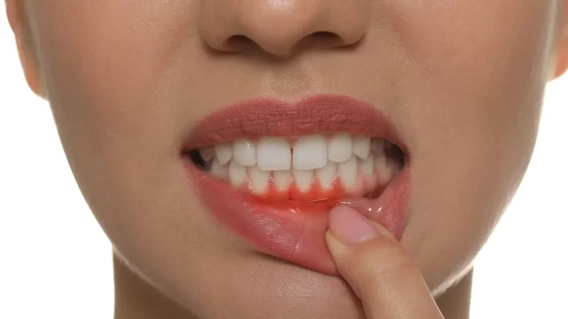 How to Treat Inflamed Gums Naturally: Remedies That Actually Work