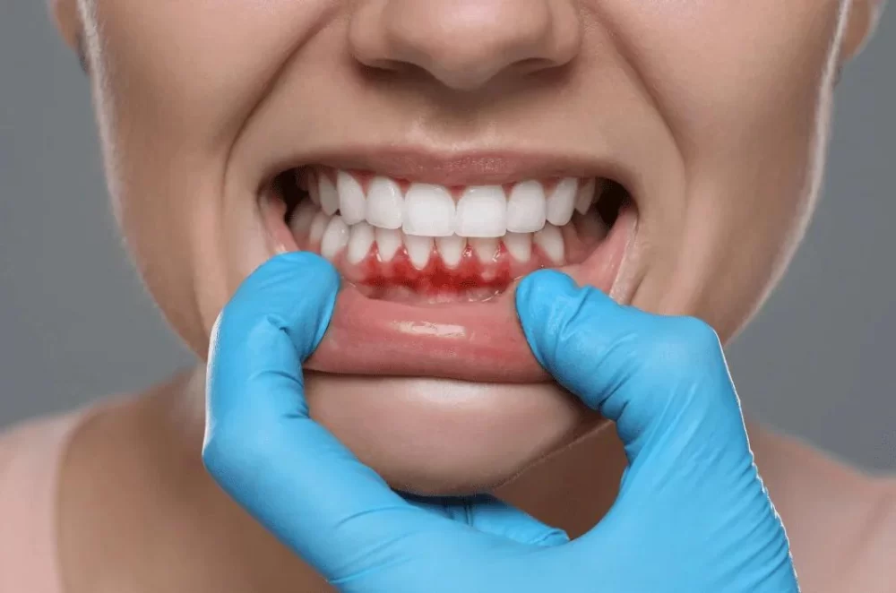 Signs of Gum Abscess: Symptoms and Effective Treatment Options