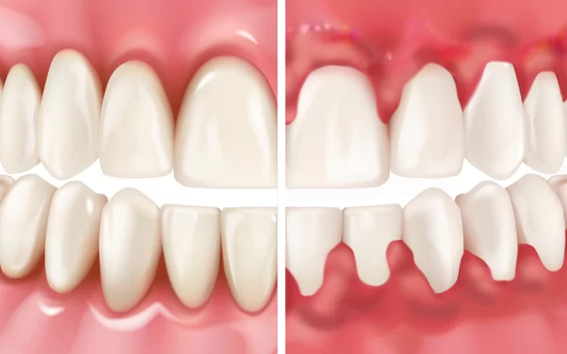 How Did I Get Gingivitis with Great Oral Hygiene? Causes and Solutions
