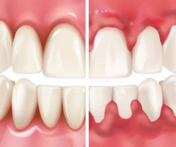 How Did I Get Gingivitis with Great Oral Hygiene? Causes and Solutions