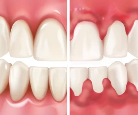 How Did I Get Gingivitis with Great Oral Hygiene? Causes and Solutions