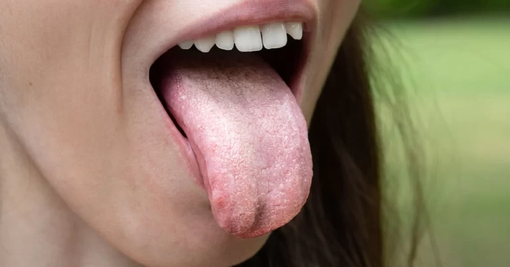Signs of Oral Fungal Infection Symptoms: What You Need to Know
