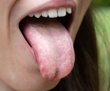 Signs of Oral Fungal Infection Symptoms: What You Need to Know