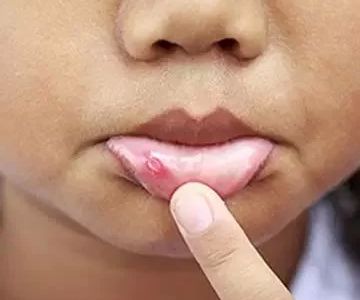 How to Treat Canker Sores Naturally and Quickly for Fast Relief