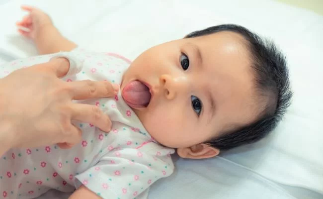 How to Treat Oral Thrush in Infants and Children: Effective Care Tips