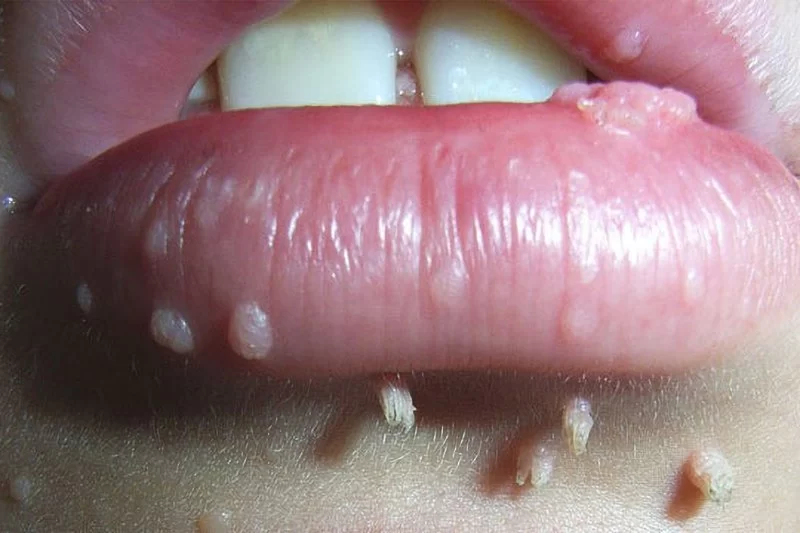 Recognizing the Signs of Oral HPV Infection in Adults