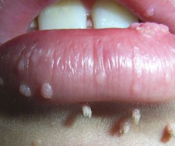 Recognizing the Signs of Oral HPV Infection in Adults