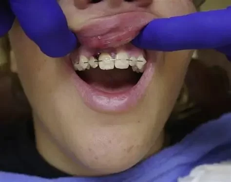 Recognizing the Early Signs of Oral Trauma for Better Dental Care