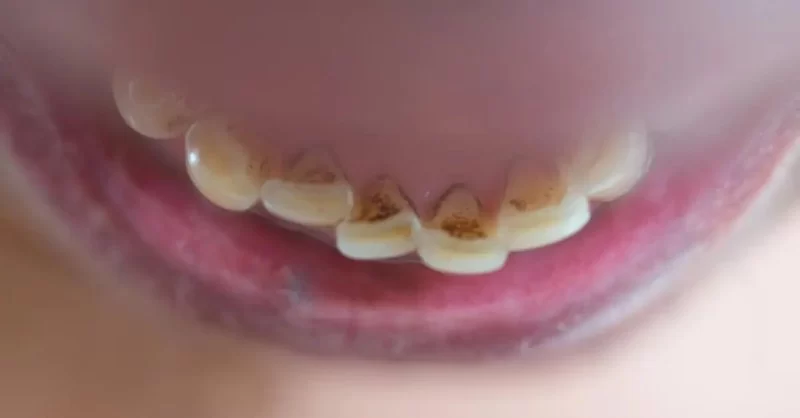 Early Signs of Dental Erosion and How to Prevent Further Damage