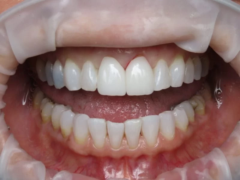 How to Prevent Tooth Discoloration Naturally and Medically