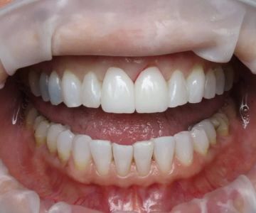 How to Prevent Tooth Discoloration Naturally and Medically