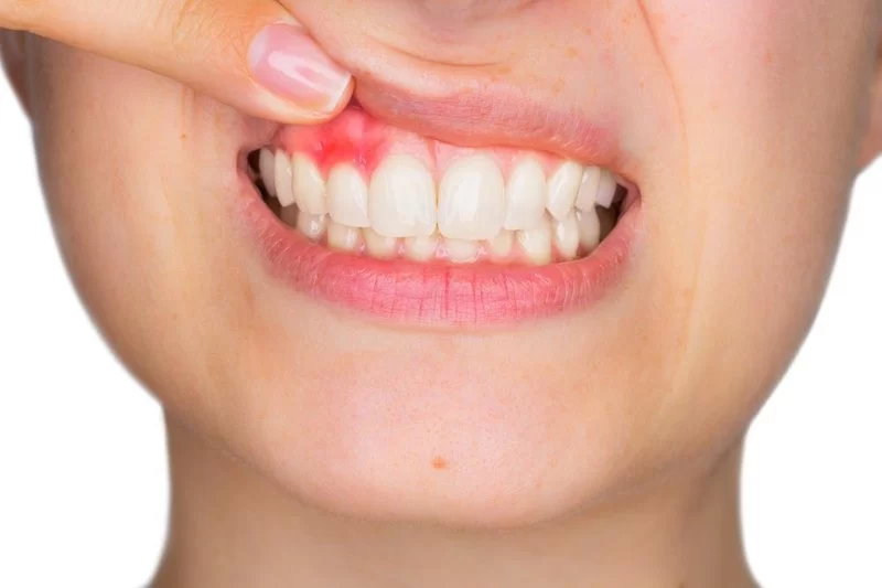 Does Hashimoto's Disease Affect the Oral Cavity? How It Impacts Your Teeth and Gums