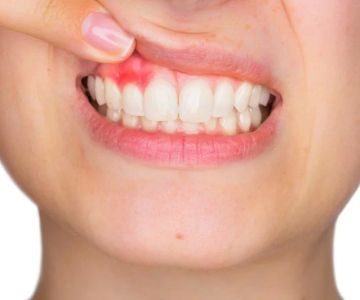Does Hashimoto's Disease Affect the Oral Cavity? How It Impacts Your Teeth and Gums