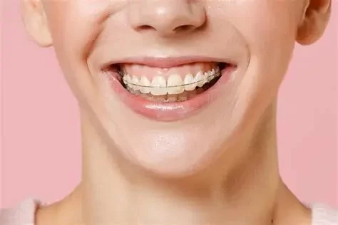 Best Dental Care Routine for Braces: Step-by-Step Tips That Work