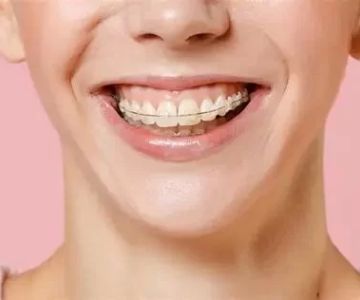 Best Dental Care Routine for Braces: Step-by-Step Tips That Work