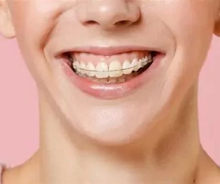 Best Dental Care Routine for Braces: Step-by-Step Tips That Work