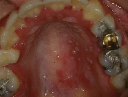 Oral Diseases That Initially Present with Vesicles: What You Should Know