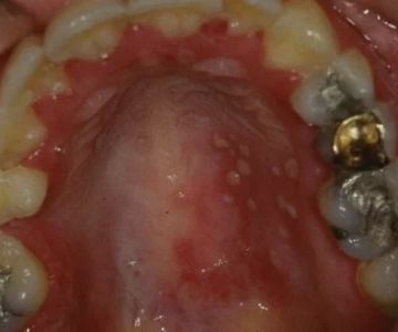Oral Diseases That Initially Present with Vesicles: What You Should Know