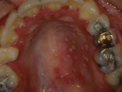 Oral Diseases That Initially Present with Vesicles: What You Should Know