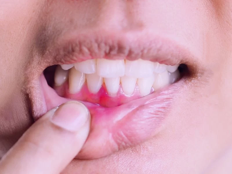 How to Treat Inflamed Gums After Dental Cleaning